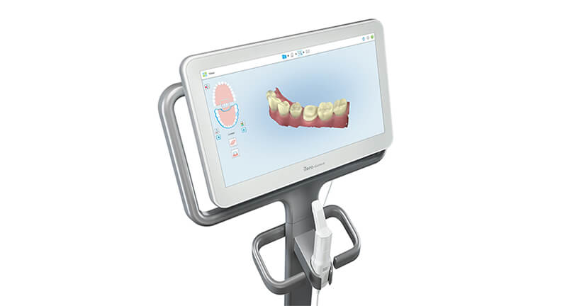 iTero(デジタルスキャナー)完備なのでシリコンの歯型採りが不要かつ精密な診断が可能