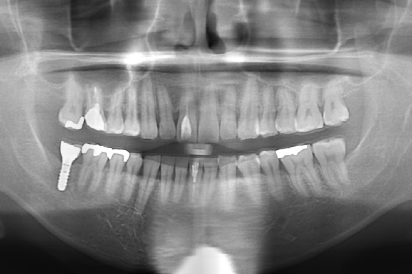 インプラント症例後
