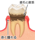 中度の歯周病