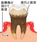 重度の歯周病