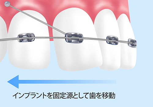 インプラント矯正