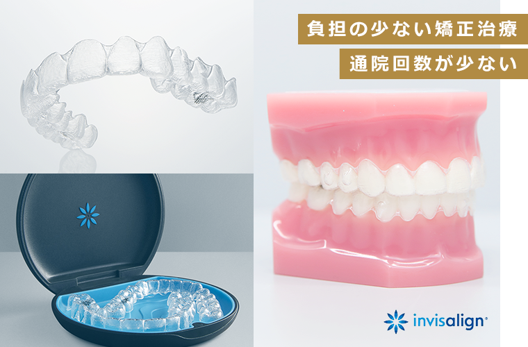 取り外し可能のマウスピース矯正