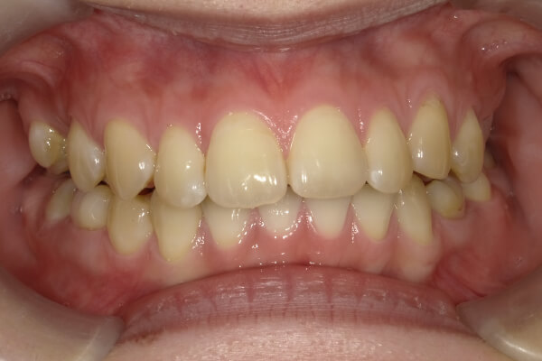 すきっ歯の症例１後