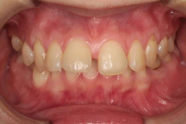 すきっ歯の症例１前