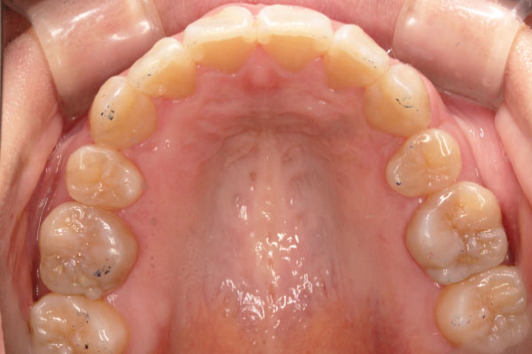 乱杭歯(叢生)の症例５後