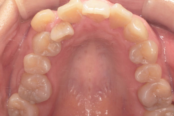 乱杭歯(叢生)の症例５前