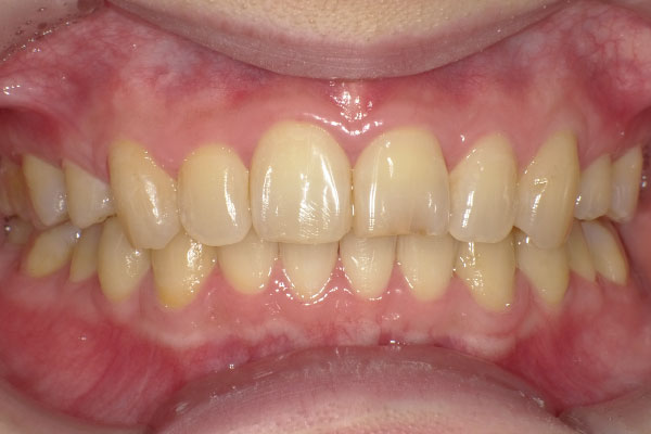 すきっ歯の症2後