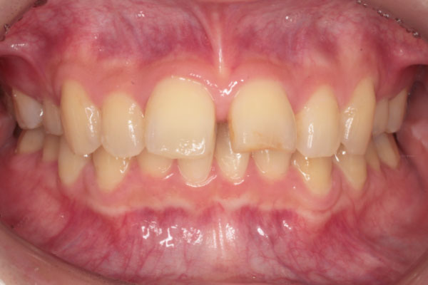すきっ歯の症例２前